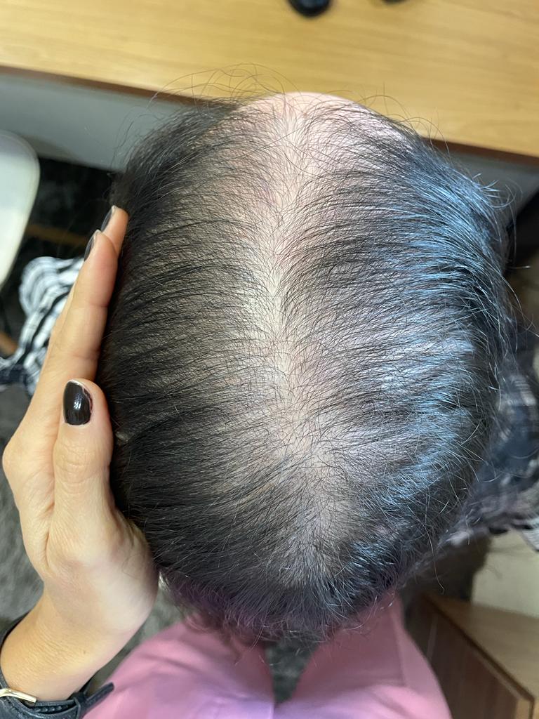 Alopecias01