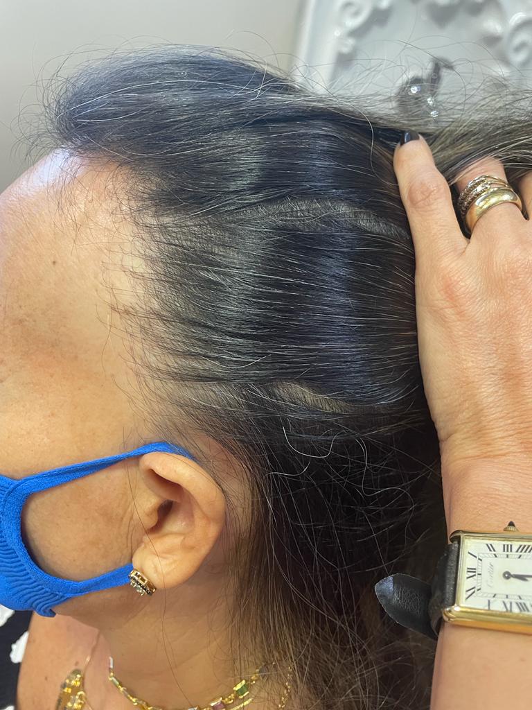 Alopecias02